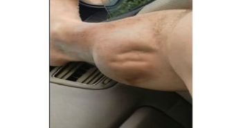 LOOK AT THE CRAMP THAT THIS MAN HAS!! THIS IS WHY YOU SHOULD ALWAYS LISTEN TO YOUR BODY!
