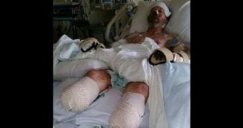 MAN’S HANDS AND LEGS AMPUTATED AFTER GETTING LICK BY A DOG MAN'S HANDS AND LEGS AMPUTATED AFTER GETTING LICK BY A DOG