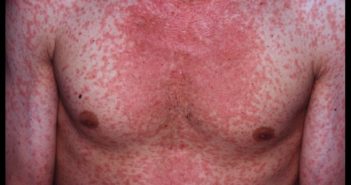 MEASLES OUTBREAK IN THAILAND! BE ADVISED! measles